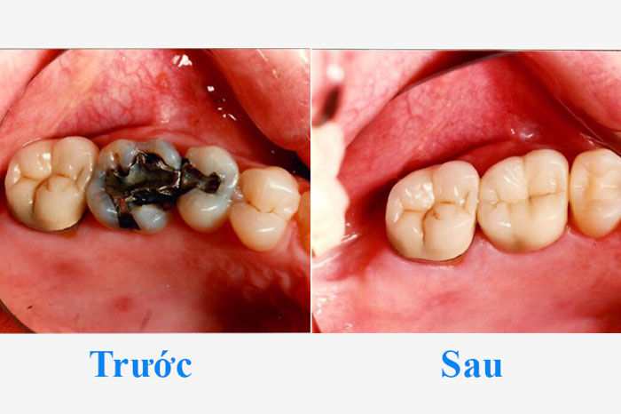 Răng sứ Titan giúp khôi phục thẩm mỹ và ăn nhai của chiếc răng hư tổn