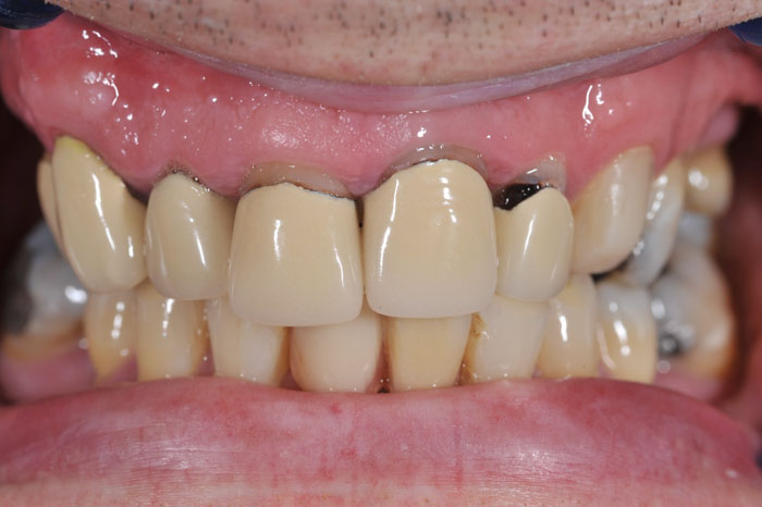 Răng sứ vênh hở lộ chân răng ra ngoài và đen ở viền nướu