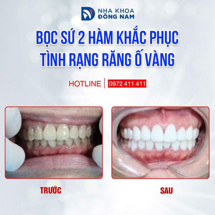 Răng sứ Zirconia phù hợp cho bệnh nhân gặp tình trạng răng nhiễm kháng sinh