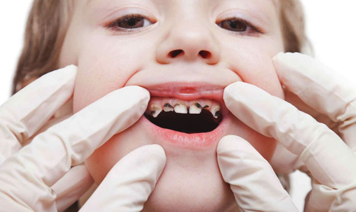 Sâu răng là tình trạng phổ biến ở trẻ nếu không vệ sinh răng miệng tốt