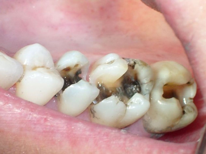 Sâu răng nặng gây viêm tủy cần phải được lấy tủy sớm nhất có thể