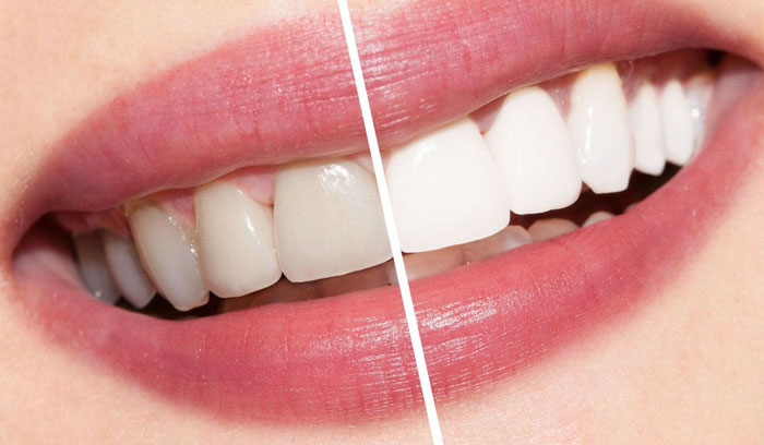 Tẩy trắng răng giúp cải thiện màu răng trắng sáng đều màu hơn