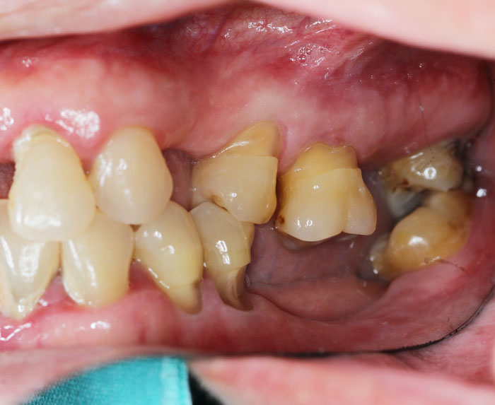 Tiêu xương răng khiến răng đối diện mọc trồi dài, dễ lung lay, gãy rụng