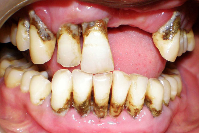 Viêm nha chu là một trong những nguyên nhân gây mất răng