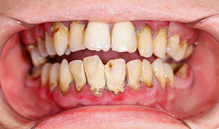 Viêm nha chu là nguyên nhân hàng đầu gây mất răng ở người trưởng thành và cao tuổi