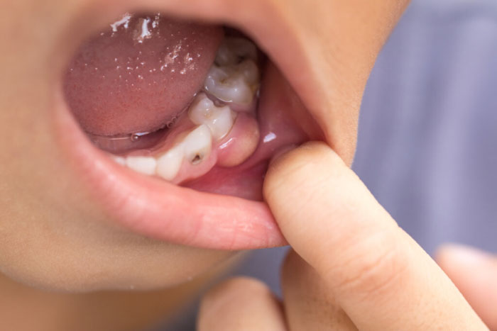 Xuất hiện ổ mủ ở chân răng là dấu hiệu của viêm tủy răng