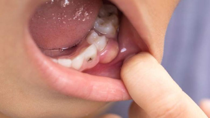 Áp xe răng là nguyên nhân hình thành thịt thừa trên răng