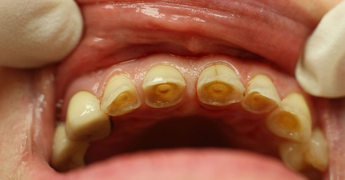 Bề mặt nhai xuất hiện vết lõm là dấu hiệu của tình trạng mòn men răng