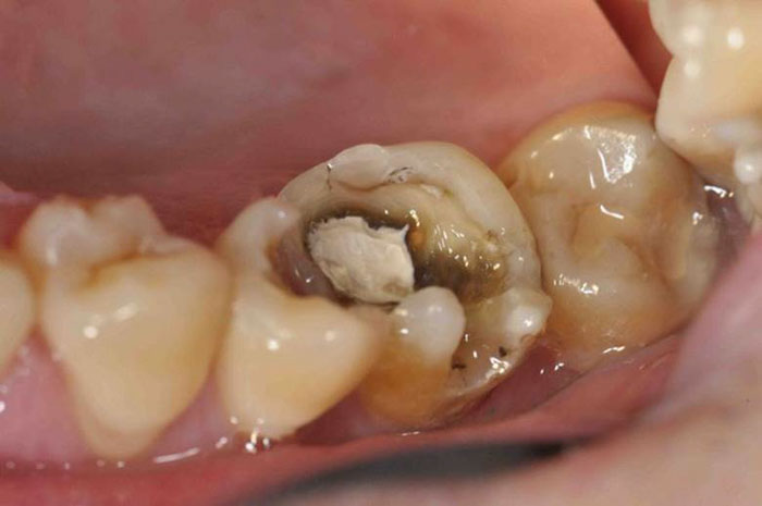 Biến chứng sâu răng là nguyên nhân gây lồi thịt trong răng