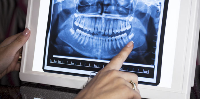 Chụp X-quang răng hỗ trợ trong việc chẩn đoán và lên phương pháp điều trị bệnh lý răng