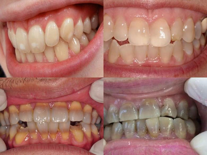 Dấu hiệu nhận biết răng nhiễm Tetracycline