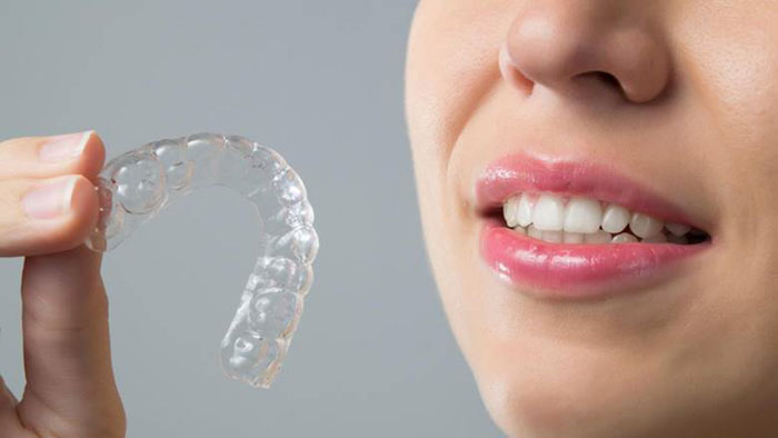 Đeo hàm duy trì ổn định răng sau khi niềng