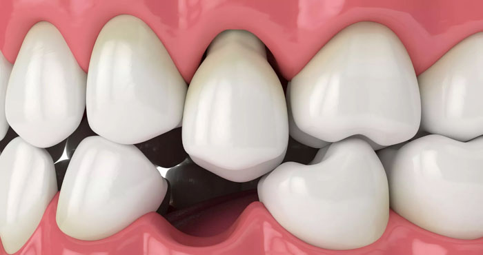 Mất răng cũng là nguyên nhân gây răng lệch lạc