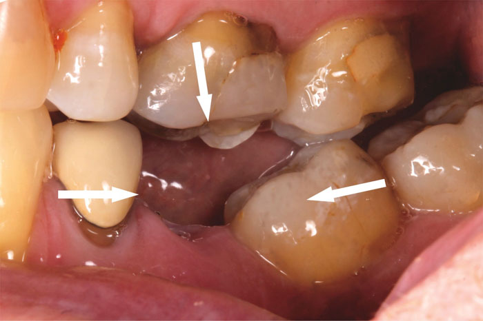 Mất răng hình thành khoảng trống khiến răng xô lệch