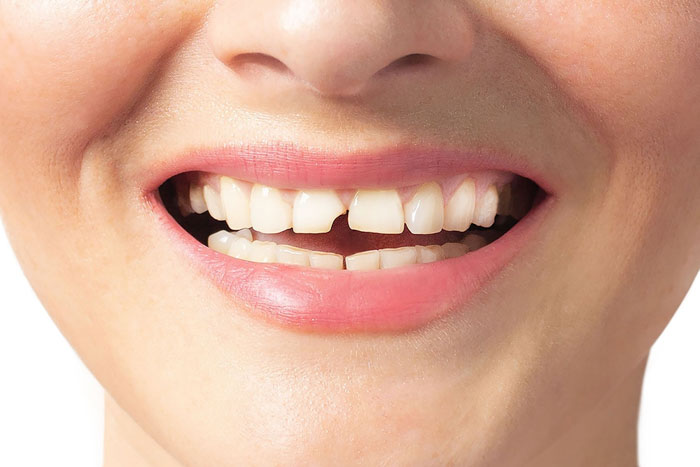 Mẻ răng cửa làm suy giảm thẩm mỹ nụ cười