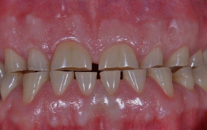 Mòn răng mặt nhai gây ảnh hưởng đến thẩm mỹ