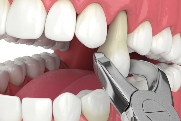 Nhổ răng khi chiếc răng bị nứt nghiêm trọng không thể bảo tồn