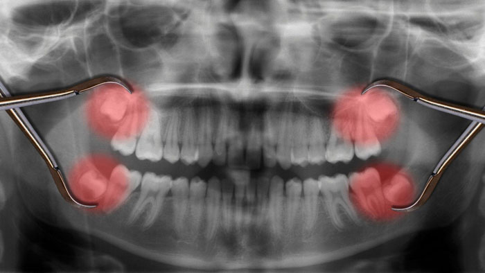 Nhổ răng khôn càng sớm càng tốt để ngăn ngừa biến chứng