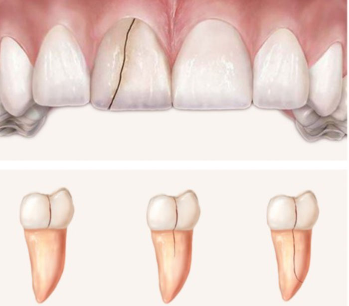 Nứt răng có nhiều mức độ nặng nhẹ khác nhau phụ thuộc vào nguyên nhân tác động
