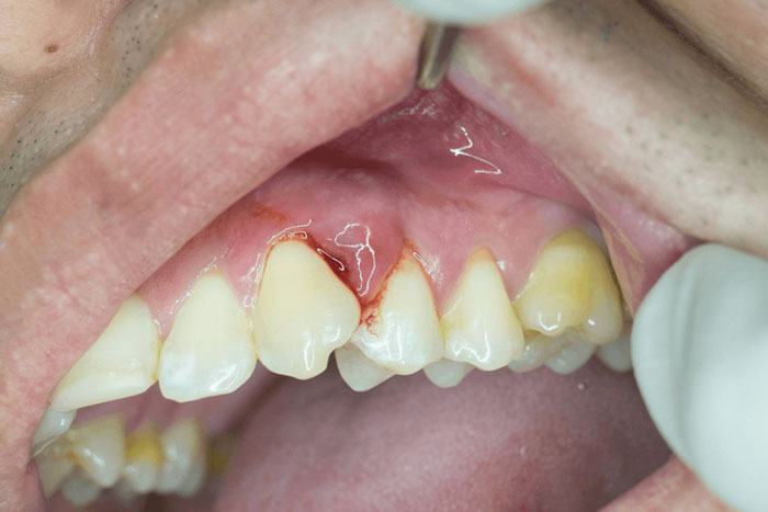 Nứt răng có thể gây ra tình trạng áp xe, nhiễm trùng