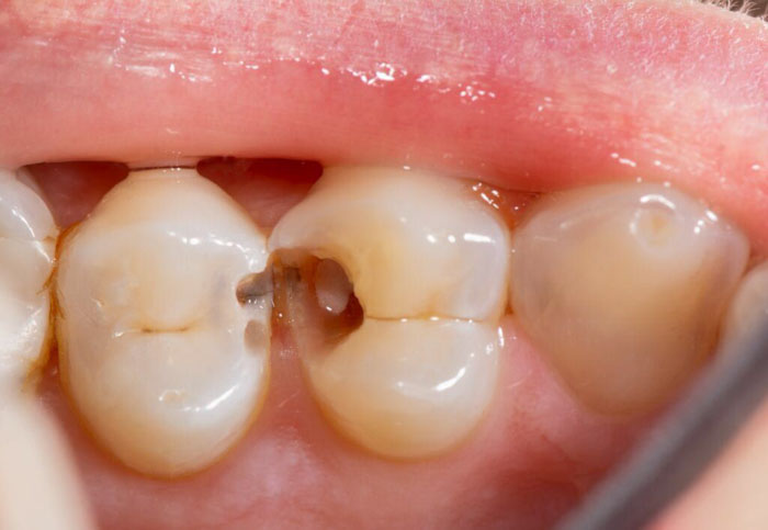Răng bị bể làm tăng nguy cơ sâu răng