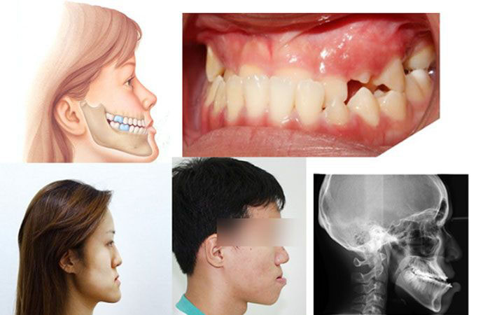 Răng bị thụt vào trong gây mất thẩm mỹ trầm trọng