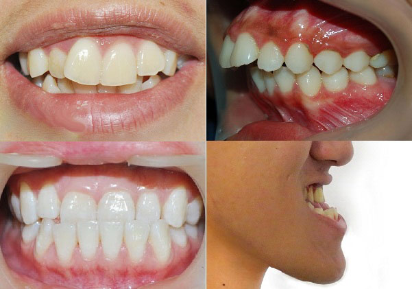 Răng cửa bị thụt vào trong là tình trạng khá phổ biến