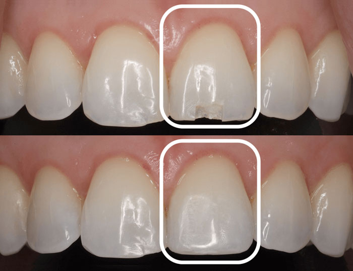 Răng cửa mẻ nhỏ có thể áp dụng phương pháp trám composite
