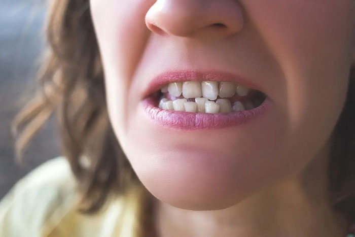 Răng cửa mọc lệch gây ảnh hưởng đến thẩm mỹ nụ cười