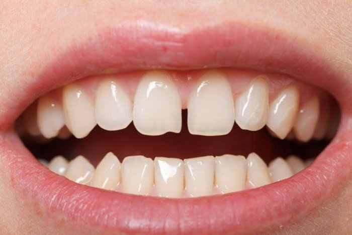 Răng cửa thưa có thể khắc phục bằng phương pháp trám răng