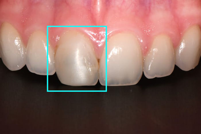 Răng cửa xuất hiện các đường nứt rất nhỏ trên bề mặt men răng