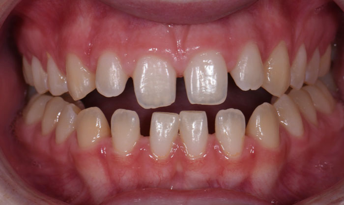 Răng hàm dưới bị thưa có thể do nhiều nguyên nhân gây nên
