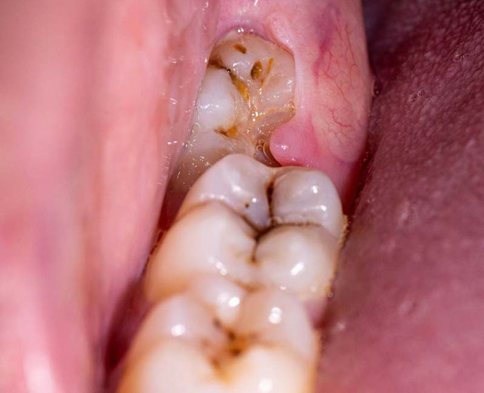 Răng khôn nằm ở vị trí khó tiếp cận khi chải răng nên rất dễ bị sâu