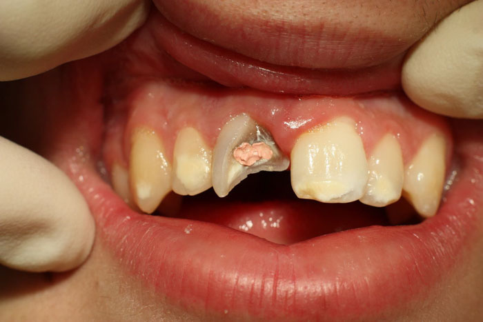 Răng mẻ lớn làm sưng viêm vùng nướu