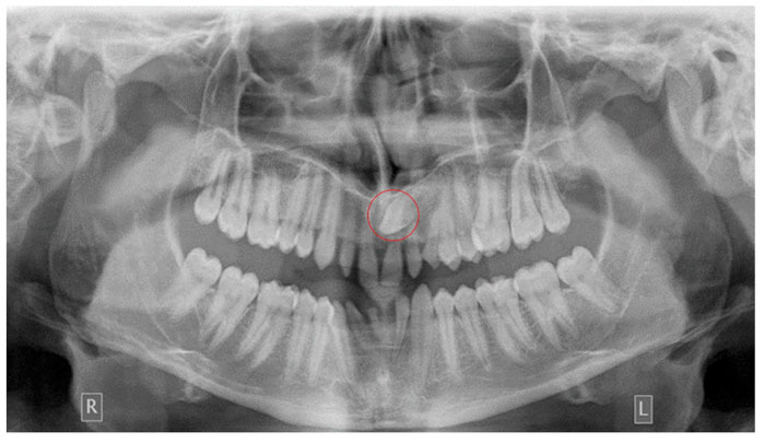 Răng mọc ngầm là chiếc răng nằm bên dưới nướu hoặc trong xương hàm