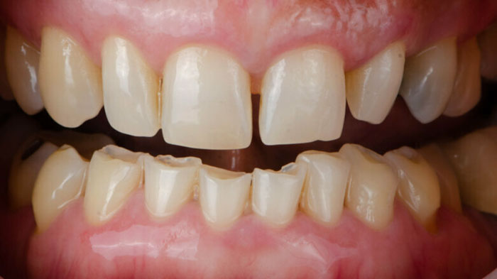 Răng mòn mặt nhai là tình trạng mất men răng hình thành vết lõm nông sâu ở mặt nhai