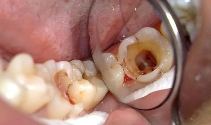 Răng sâu mẻ lớn không phù hợp trám răng để khắc phục