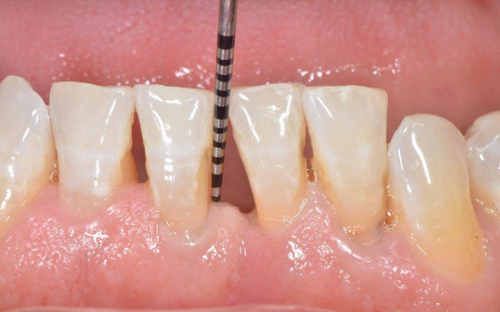 Răng thưa dễ làm phát sinh nhiều bệnh lý nguy hiểm ở răng miệng