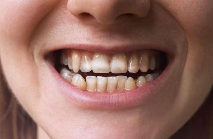 Răng xuất hiện nhiều đốm trắng đục có thể là dấu hiệu men răng yếu