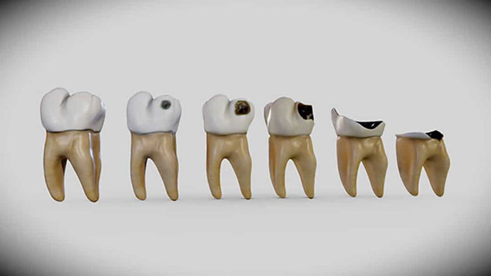 Sâu răng chỉ phát triển ngày càng nặng chứ không thể tự khỏi được