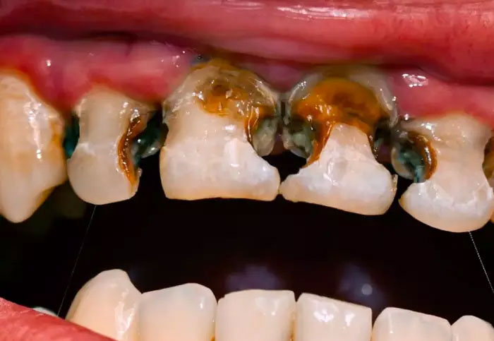 Sâu răng cửa nghiêm trọng có thể gây ra tình trạng mất răng
