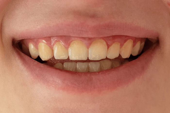 Tẩy trắng răng áp dụng cho trường hợp răng ố vàng nhẹ do thực phẩm