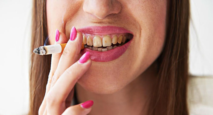 Thành phần nicotine trong thuốc lá là nguyên nhân gây ố vàng răng