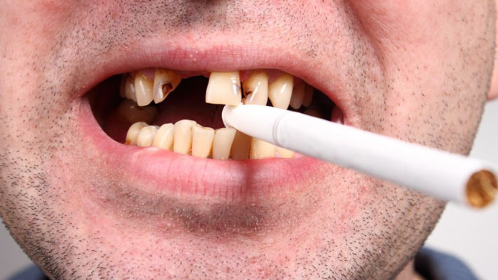 Thói quen hút thuốc lá khiến răng dễ bị sâu hỏng hơn bình thường