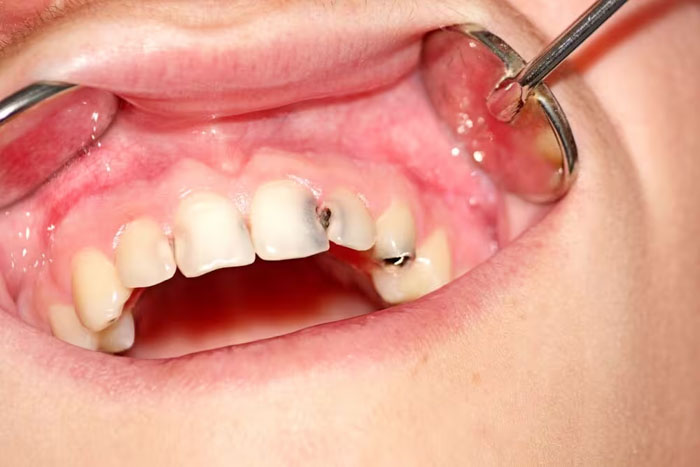 Trám răng có thể áp dụng cho răng cửa bị sâu