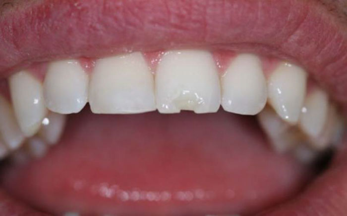 Trám răng cũng không áp dụng được với răng sứ bị mẻ vỡ