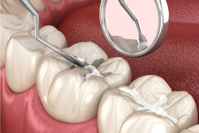 Trám răng trong trường hợp răng nứt nhẹ