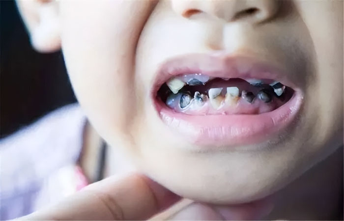 Trẻ em là đối tượng rất dễ mắc bệnh lý sâu răng