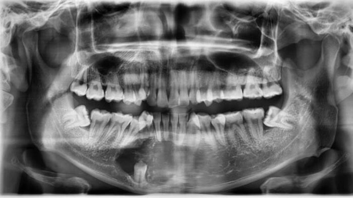 U nang răng làm tiêu xương hàm