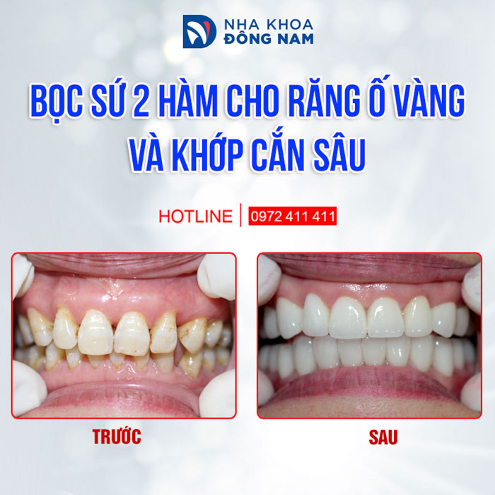 Bọc sứ Zirconia khắc phục răng ố vàng khớp cắn sâu